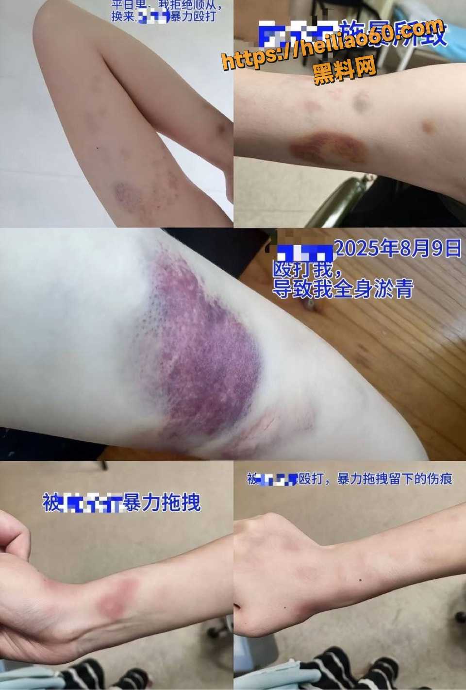 女子术后被领导强奸事件2
