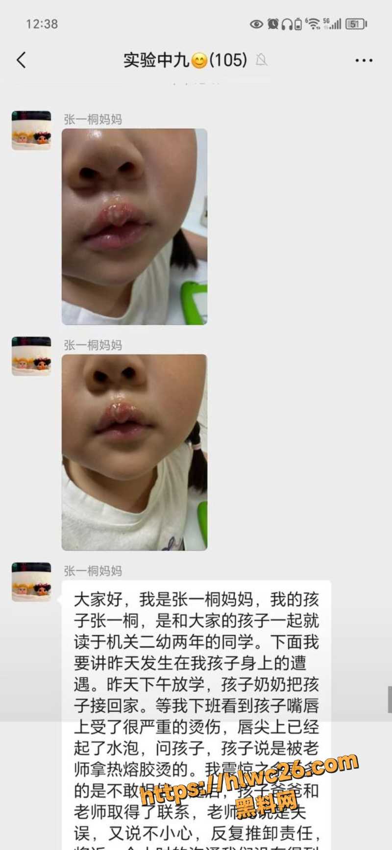 陈玉用热熔胶伤害子孩3
