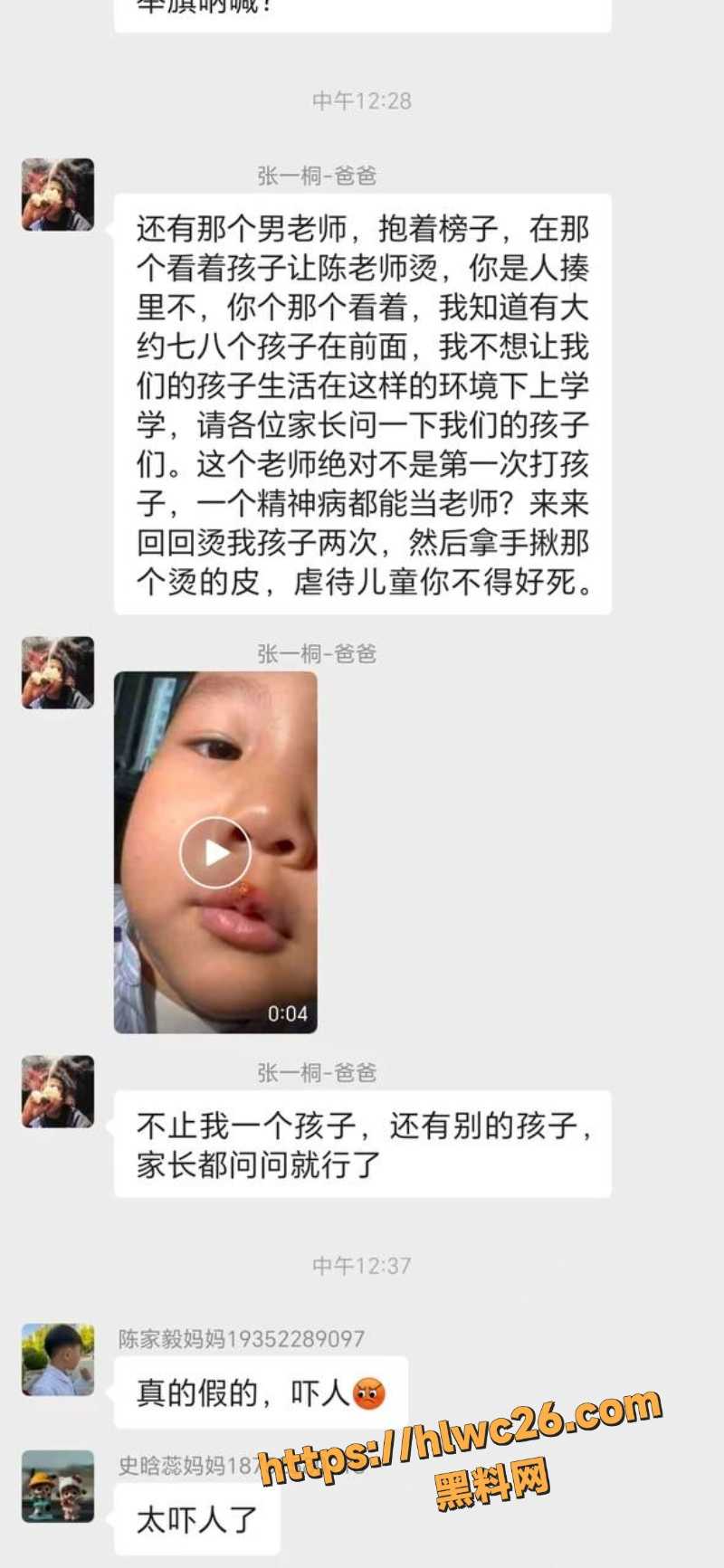 丰县机关二幼子孩烫伤事件7